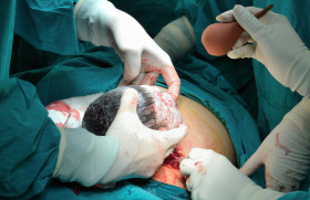 Utilisation de l’acide tranexamique pour prévenir les hémorragies du post-partum en cas de césarienne