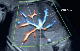 La vascularisation abdominale fœtale et ses anomalies